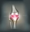 Osteoarthritis knee joint destruction