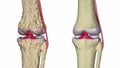 Osteoarthritis : Knee joint with ligaments and cartilages