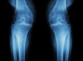 Osteoarthritis Knee ( OA Knee ) ( Film x-ray both knee with arthritis of knee joint : narrow knee joint space ) ( Medical and