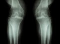 Osteoarthritis Knee ( OA Knee ) ( Film x-ray both knee with arthritis of knee joint : narrow knee joint space ) ( Medical and