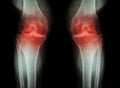 Osteoarthritis Knee ( OA Knee ) ( Film x-ray both knee with arthritis of knee joint : narrow knee joint space ) ( Medical and Royalty Free Stock Photo