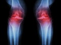 Osteoarthritis Knee ( OA Knee ) ( Film x-ray both knee with arthritis of knee joint : narrow knee joint space ) ( Medical and