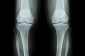 Osteoarthritis Knee ( OA Knee ). Film x-ray both knee ( front view ) show narrow joint space ( joint cartilage loss ) , osteophyte