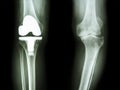Osteoarthritis knee patient and artificial joint