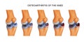 Osteoarthritis of the knee Royalty Free Stock Photo