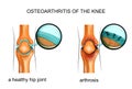 Osteoarthritis of the knee