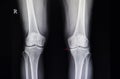 osteoarthritis of knee