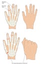 Osteoarthritis nodes