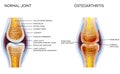 Osteoarthritis