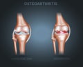 Osteoarthritis and normal joint anatomy