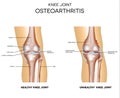 Osteoarthritis and normal joint Royalty Free Stock Photo