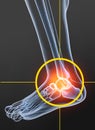 Osteoarthritis, painful ankle joint, 3D illustration Royalty Free Stock Photo