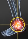 Osteoarthritis, painful ankle joint, 3D illustration