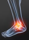 Osteoarthritis, painful ankle joint, 3D illustration Royalty Free Stock Photo