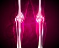 Osteoarthritis, painful joint and healthy joint