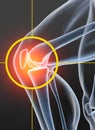 Osteoarthritis, painful knee joint, 3D illustration on black background