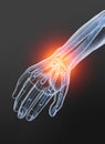 Osteoarthritis, painful wrist joint, 3D illustration on black background Royalty Free Stock Photo