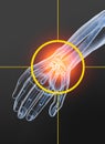Osteoarthritis, painful wrist joint, 3D illustration 2