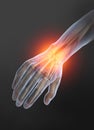 Osteoarthritis, painful wrist joint, 3D illustration Royalty Free Stock Photo