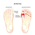 Osteoarthritis, rheumatoid arthritis, and posttraumatic arthritis