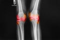 Osteoarthritis Right knee film x-ray AP anterior - posterior of knee