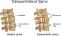 Osteoarthritis of Spine Royalty Free Stock Photo