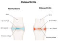 Osteoarthritis Synovial Joint Royalty Free Stock Photo