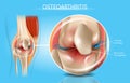 Osteoarthritis Realistic Vector Medical Scheme