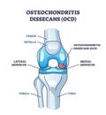 Osteochondritis dissecans or OCD bone and cartilage condition outline diagram