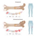Osteogenesis and osteosarcoma. Cancerous tumor of a human bone