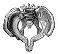 Osteomalacia pelvis.