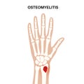 Osteomyelitis of arm