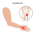 Osteomyelitis of arm