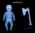 Osteomyelitis in children