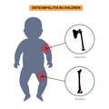 Osteomyelitis in children