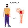 Osteomyelitis of hip