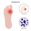 Osteomyelitis of feet