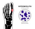 Osteomyelitis of feet