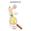 Osteomyelitis is infection in the bone. Close-up bacteria Staphylococcus aureus that caused this disease. Vector diagram shows