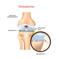 Osteophyte. Human knee joint with osteoarthritis