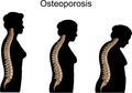 Osteoporosis