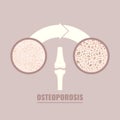 Osteoporosis bone density loss disease medical infographics