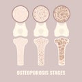 Osteoporosis bone density loss disease medical infographics
