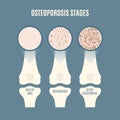 Osteoporosis bone density loss disease medical infographics
