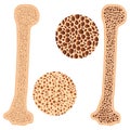 Osteoporosis bone and healthy bone.