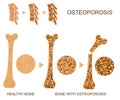 Osteoporosis Bone Infographics Concept Card Poster. Vector