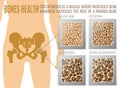 Osteoporosis Bones Poster Royalty Free Stock Photo