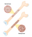 Osteoporosis. disease of bones Royalty Free Stock Photo