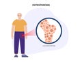 Osteoporosis medical poster Royalty Free Stock Photo