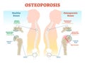 Osteoporosis examples vector illustration diagram with bone density.